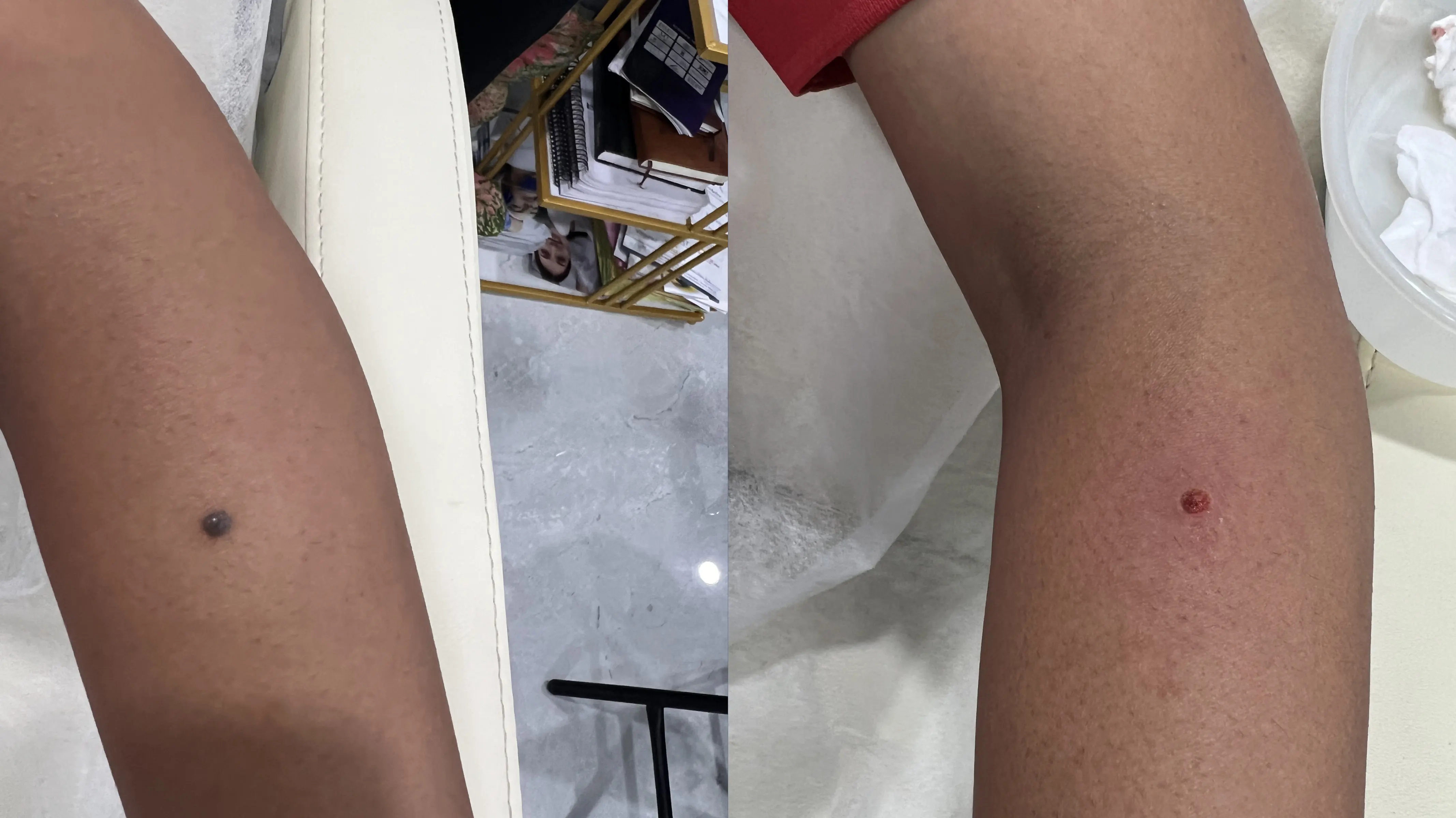 Wart Removal Results